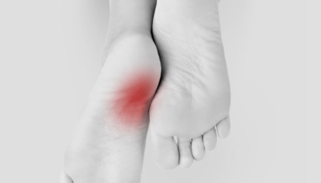 Plantar Fasciitis - Gray Foot and Orthotic Clinic