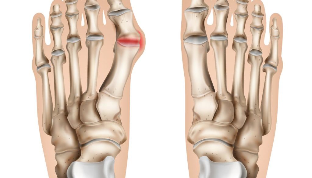 Natural Non-Surgical Bunion and Bunionette Treatment at Vancouver Orthotic Clinics 