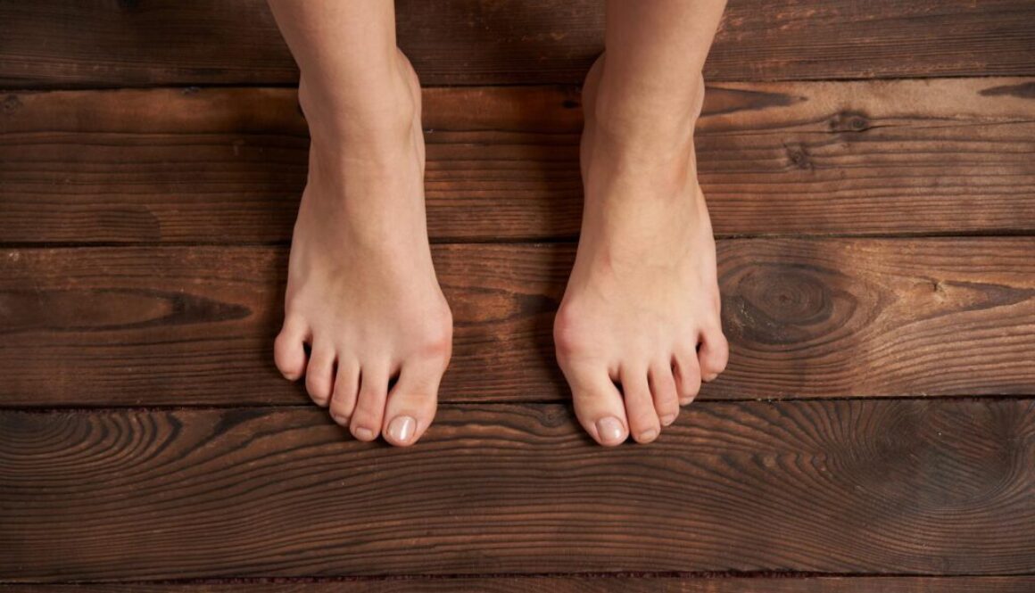 Bunion and Bunion Treatment