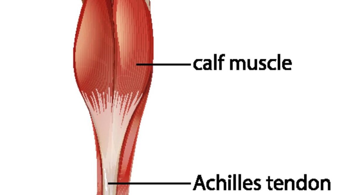 Achilles Tendonitis Pain: Causes, Treatment, and Prevention Explained by Vancouver Orthotic Clinics 