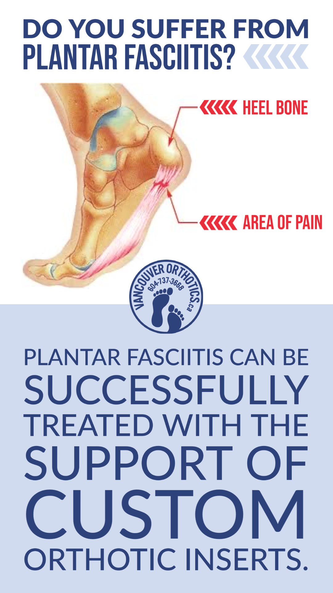 Patient walking comfortably after custom orthotics treatment for plantar fasciitis in Vancouver