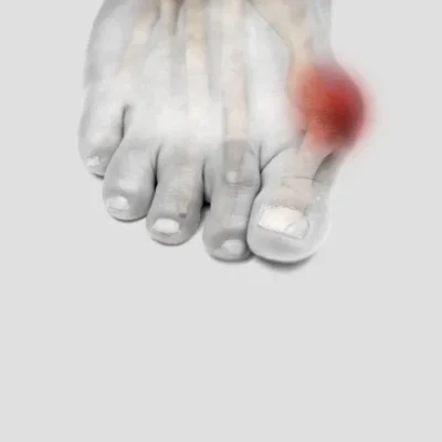 Bunion 