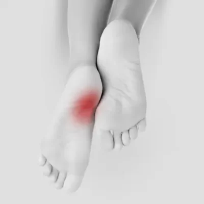 Plantar Fasciitis